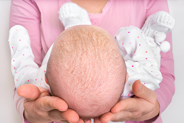 شوره سر در کودکان